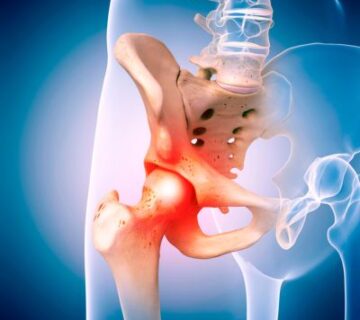 Medical illustration showing the human hip joint with inflammation, highlighting the pelvic bone, femur, and affected joint area in red—helpful for those seeking physical therapy in Medford 